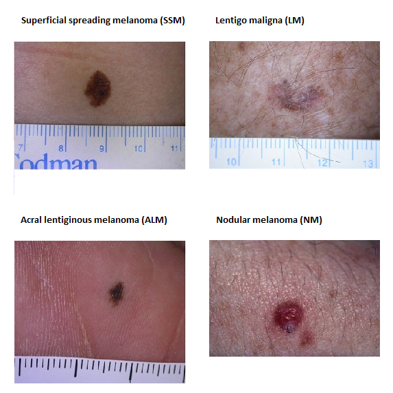 Superficial Spreading Malignant Melanoma